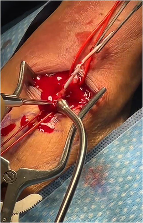 Intraoperative visualization of retained catheter with clot.