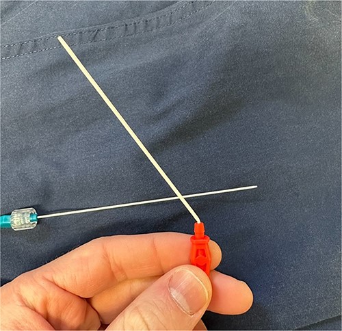 Kinked catheter once dilator is removed.