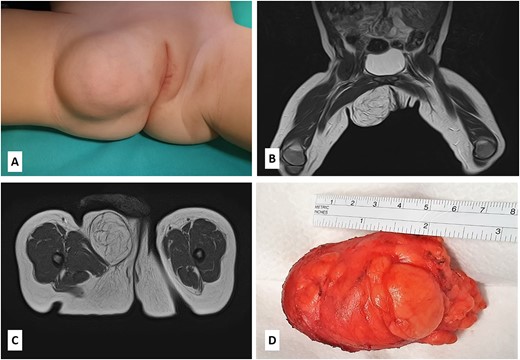 (A) The patient presented with a nontender, mobile, round mass of the right labiocrural fold; (B–C) MRI scan revealed a not well-demarcated mass measuring 6.6 × 4.8 × 4.4 cm; the mass mainly comprised fatty signal intensity; (D) the gross appearance of the specimen showing a lobulated, solid fatty mass with a thin, fibrous capsule.