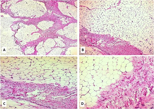 (A–D) Hematoxylin and eosin slides of the biopsy revealed a neoplasm composed of lobules of mature adipose tissue admixed with fibroblastic foci consisting of bland fibroblasts involving adipose septa with preserved lobular architecture; magnifications: 5× (A), 10× (B), 20× (C), and 40× (D).