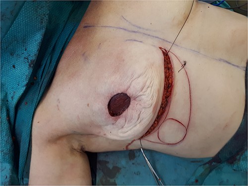 The SSMx is performed through the periareloar and IMF incisions.