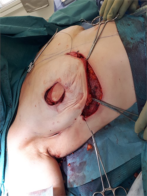 The MICAP flap bearing the preserved disk of skin (new areola) is mobilized until it reaches the desired position.