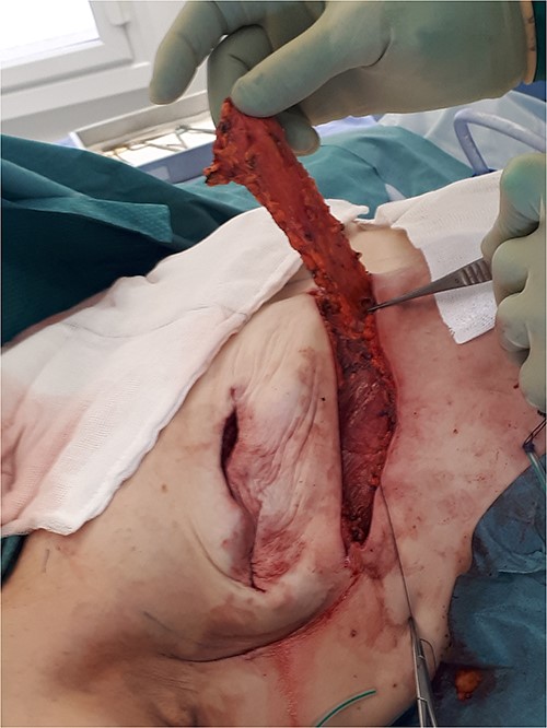 The abdominal flap is mobilized and re-sutured to recreate the new IMF.