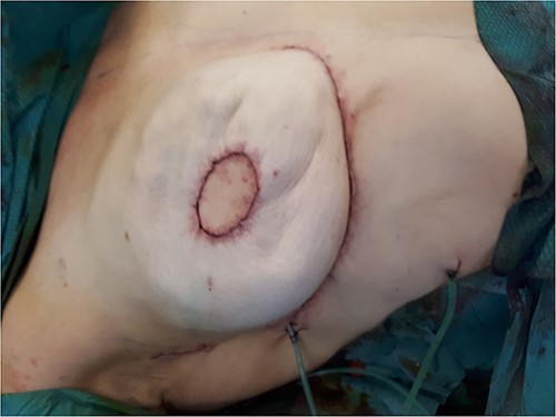 Pre-pectoral expander remains under-inflated to avoid the compression the the vascular pedicle of the MICAP flap.