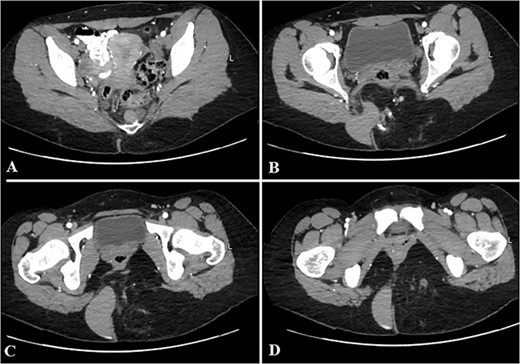 Selected axial CT cuts of the pelvis with oral and IV contrast (Arterial phase) from above downward (A–D), showing the mentioned gluteal mass measuring about 9 × 15 × 0.5 cm3. The boundaries of the lesion were not clearly defined and the dimensions were assumed based on its mass effect on the adjacent structures. The lesion consisted of mixed tissues (fat predominantly, fluid and calcifications). The fluid portion appeared on the right aspect of the gluteal region with high density, indicating mucinous/proteinaceous content. Extensions into the ischio-rectal fossa are noted with minimal pre-coccygeal components seen as well.