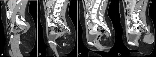 Selected sagittal CT cuts of the pelvis with oral and IV contrast (Venous phase) from left to right sides of the body (A–D), showing the mentioned gluteal mass. The cystic component of the mass is noted at the right gluteal region and the pre-coccygeal portion is well shown in C.