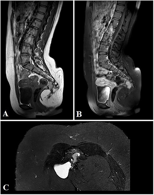 Selected sagittal MRI images (T1-sequence) without (A) and with contrast (B), both showing the extension of the mass with a visible pre-coccygeal component. The tumor is seen composed of mixed solid (predominantly fat) and cystic (fluid) components. The cystic component appears hyper-intense on the STIR sequence (C).