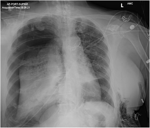 AP supine chest radiograph showing right-sided pneumothorax.