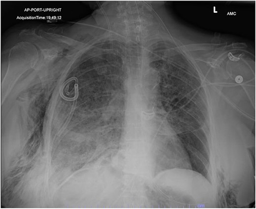 AP upright chest radiograph showing placement of right-sided chest tube and resolution of right pneumothorax.