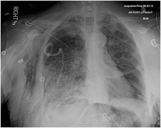 AP upright chest radiograph showing intraabdominal free air, right-sided chest tube in place, and bilateral chest wall subcutaneous emphysema that is worse on the right. Bilateral patchy airspace disease is noted as well.