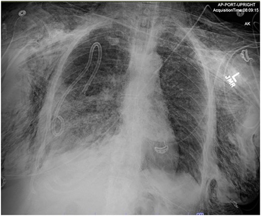 Post-operative chest radiograph showing increased diffuse subcutaneous emphysema in chest, lower neck and upper left abdominal wall. Previously demonstrated pneumoperitoneum is not visualized on the current film.
