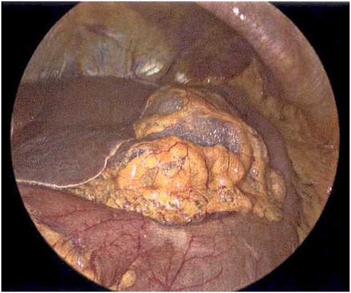 Laparoscope revealing emphysematous changes within the gastrohepatic ligament.
