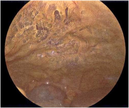 Laparoscope of the anterior abdominal wall revealing emphysematous changes within the preperitoneal space.