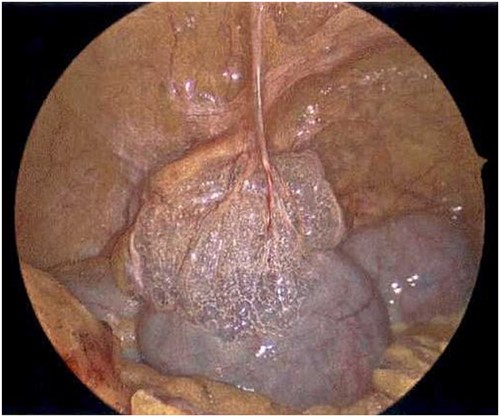 Laparoscope of the large bowel revealing subserosal emphysema within the adventitia.