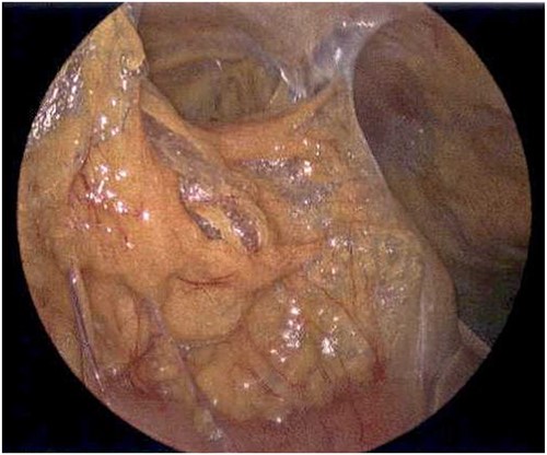 Laparoscope of the right paracolic gutter revealing emphysematous changes of the mesentery.