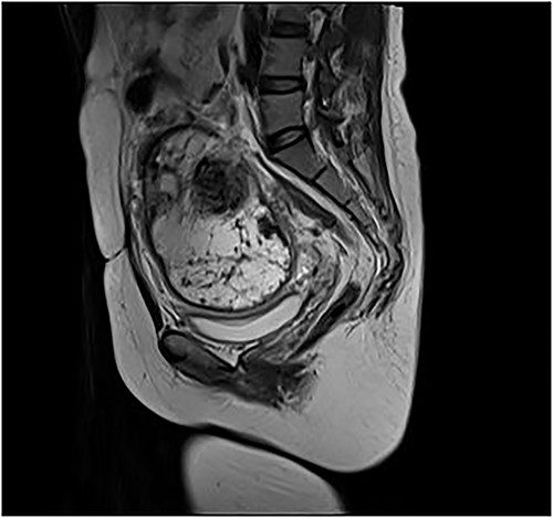 Pelvic enhancement MRI showing large intra-abdominal mass.
