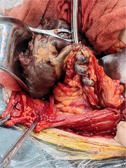 Resected parasitic leiomyoma along with its vascular pedicle.