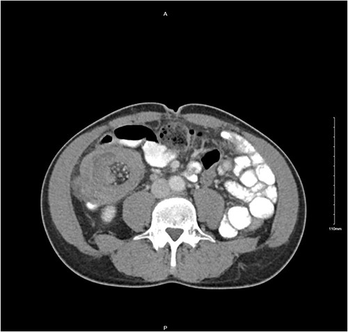 Transverse CT image of small bowel intussusception into the ascending colon.