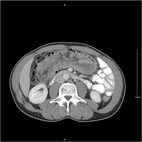 Transverse CT image demonstrating long segment of small bowel telescoping towards splenic flexure of the colon.