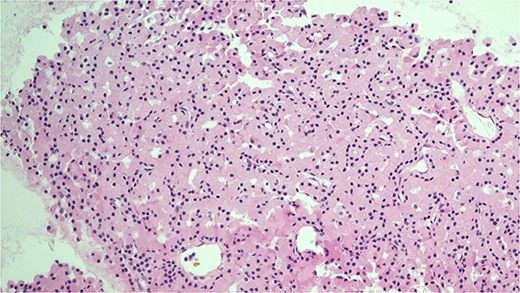 H&E stain of the FNA showing oncocytic cells with abundant eosinophilic granular cytoplasm from EBUS biopsy.
