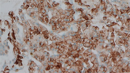Immunocytochemical stain for PTH which is positive in the cells from EBUS biopsy.