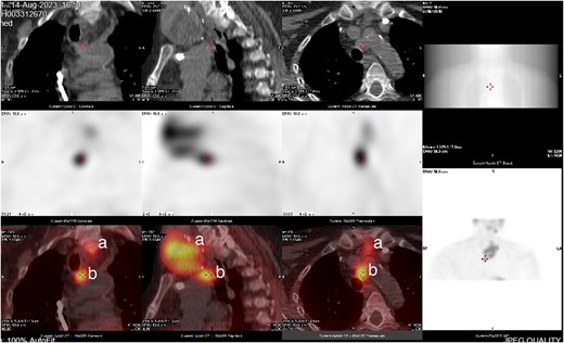 CT neck and sestamibi scan of coronal, sagittal, and axial view of superior mediastinum with mediastinal ectopic parathyroid nodule. (a) Thy3A thyroid nodule; (b) mediastinal parathyroid nodule.