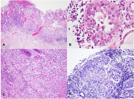 (A–D) Infiltration of the gastric mucosa by a solid neoplasm, organized in nests and composed by large, eosinophilic cells with moderate to marked nuclear pleomorphism (A—HE, 40X); foci of dyskeratosis may be seen (B—HE, 400X). Histochemical stains for mucin show a lack of staining in viable squamous cells (C—PAS, 100X; D—Mucicarmim).