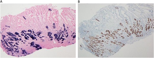 (A–B) Immunohistochemical study reveal tumor cells positive for P40 (A, 40X) and diffuse positivity for EBER in situ hybridization (B, 40X).
