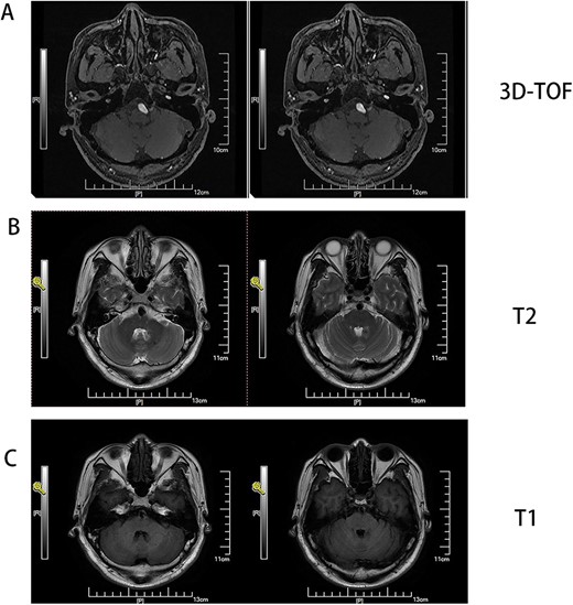 (A) MRI 3D-TOF(3 digital- time of flight), (B) MRI T2, C:MRI T1. Basilar trunk dilation up to 9 mm of diameter deviated path to the left side responsible of medulla compression.
