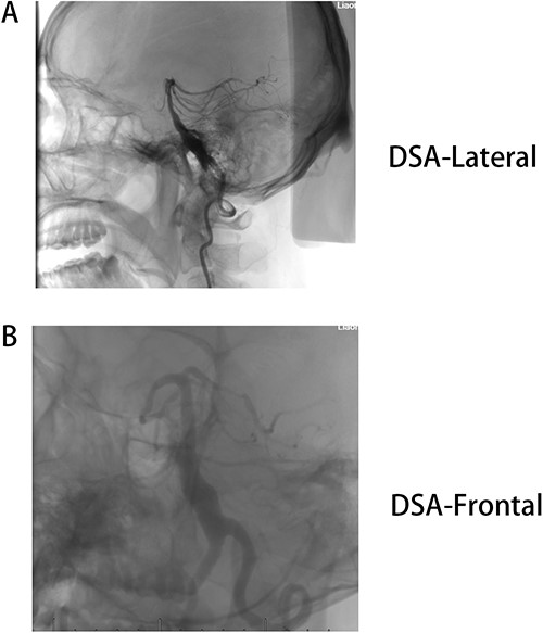(A) DSA-lateral, (B) DSA-Frontal. Basilar trunk dilation up to 9 mm of diameter and extended over 25 mm of length with a tortuous and deviated path to the left side.
