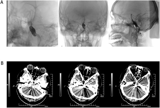 (A) Coil and stent implantation for VBD, and show peripheral blood supply after operation. (B) Non-contrast axial CT scan of the brain showing VBD after surgery.