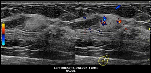 Ultrasound images of the lesion demonstrating an irregular hyperechoic lesion with internal vascularity.