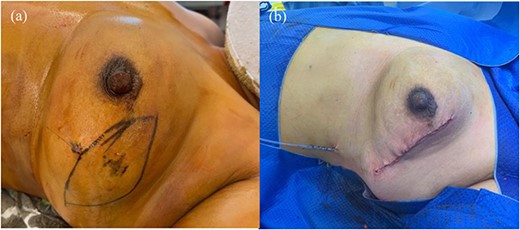 Operative images, (a) Pre-operative marking of excision margin with wire in-situ. (b) Wound following wide local excision of the tumour with ellipse of skin and primary closure.