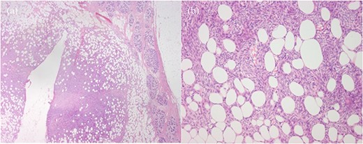 Histopathology, (a) Haematoxylin and eosin (H&E)-stained section of breast parenchyma showing lactational change and containing an ill-defined spindled cell tumour and a central defect from localisation wire. (b) H&E section of tumour with bland spindled cells in tight storiform arrays that infiltrate and entrap adjacent adipocytes (fat), producing a honeycomb pattern.