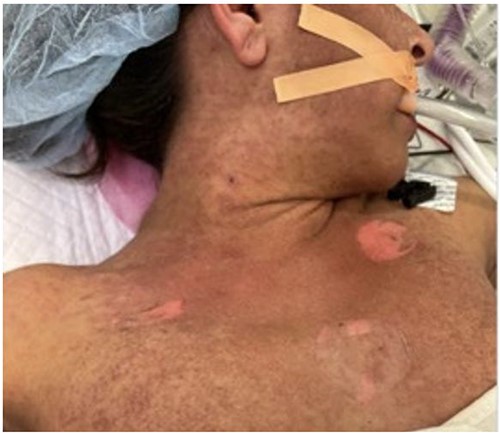 Initial photo of the rash in the operating room during her takeback surgery.