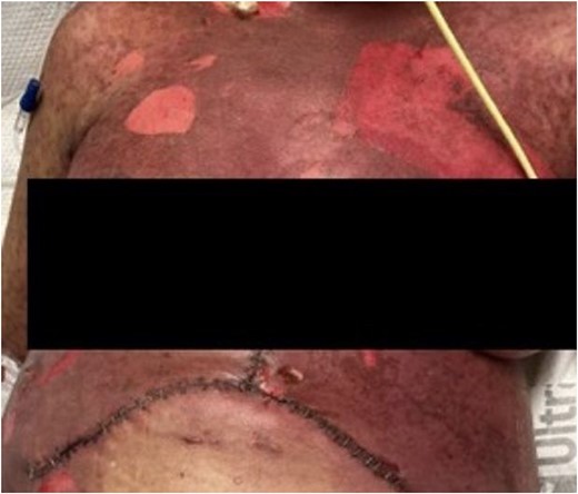 Further progression of her rash a week following developing SJS. She also had significant mucosal sloughing which is not shown in this photo.