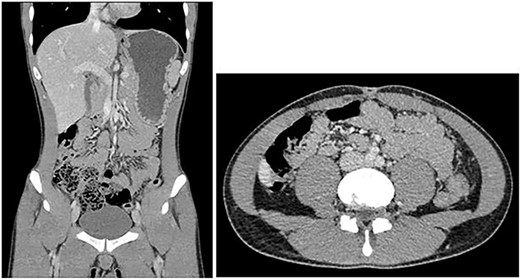 CT abdomen pelvis showing gas and fluid-filled structure in pelvis.