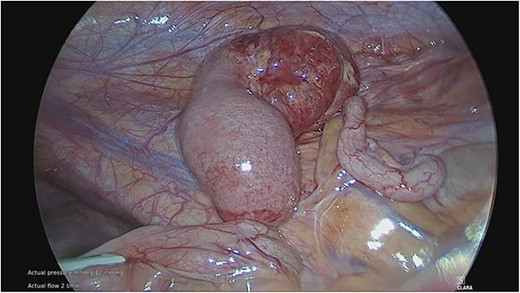 Torted MD with gangrenous distal portion. Adjacent appendix appears mildly injected.