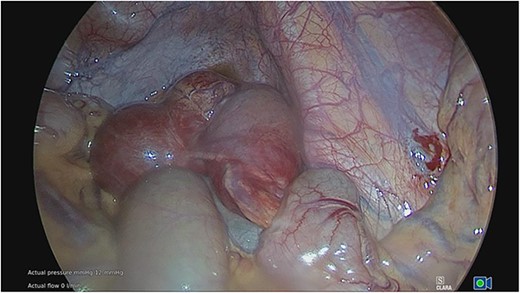 Congenital band associated with giant MD.