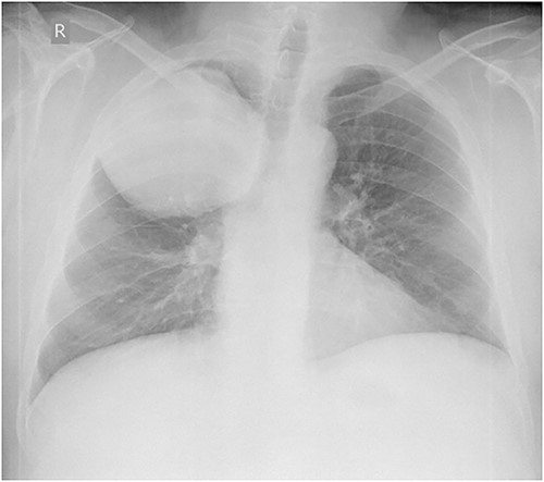 Anteroposterior chest X-ray. Giant, homogeneous, clearly circumscribed opacity in the upper part of the right chest.