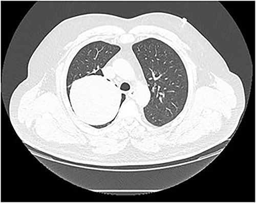 Chest CT scan. A well-defined solid nodule of 10 cm in diameter in the right upper lobe.