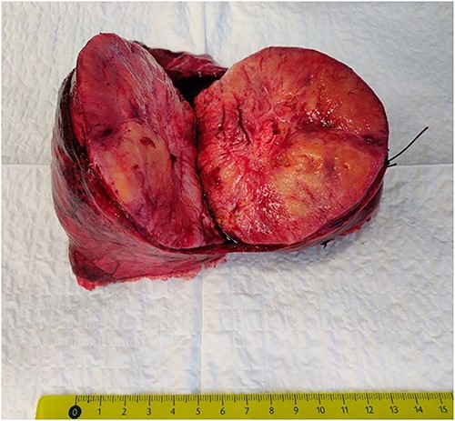The intrapulmonary tumor.
