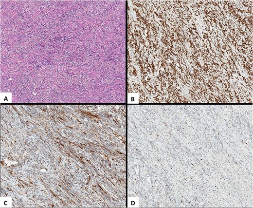 Pathological images. (A) HEx10. An SFT is composed of spindle-shaped cells with indistinct cell borders arranged haphazardly or in short, ill-defined fascicles. (B) STAT6x10. Highly sensitive (98%–100%) and specific (100%) nuclear marker for SFT at all anatomical locations, regardless of tumor morphology. (C) CD34x10. An SFT with limited membranous CD34 expression. (D) Ki-67x10. An SFT, Ki-67 (nuclear marker of cell proliferation) expression.