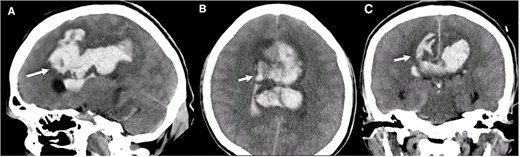 Brain CT without contrast shows a large interhemispheric hematoma, intraventricular hemorrhage, and subarachnoid hemorrhage (white arrows) in (A) Sagittal, (B) Axial, and (C) Coronal views.