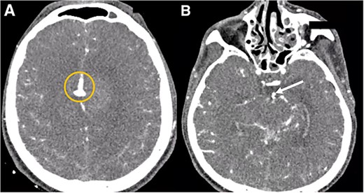 Cerebral angiotomography. (A) Axial cut depicts a midline irregular vascular lesion (yellow circle). (B) Axial cut shows a small saccular aneurysm at the basilar artery (white arrow).