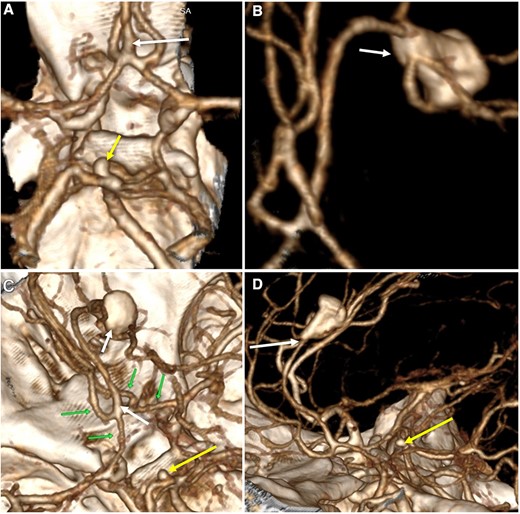 Three-dimensional reconstruction imaging. (A) Superior view of the Circle of Willis shows a variant of the ACA with an accessory A2 branch (white arrow) and a saccular aneurysm of 3.3 × 2.8 mm at the basilar artery (yellow arrow). (B) Inferior–superior view depicts the configuration of the ACA with a triplicated A2 segment and a fusiform aneurysm of 12 × 7 mm emerging in its distal portion, with branches arising from the aneurysm sac (white arrow). (C) Superior view of the anterior and posterior circulation exhibits the complex anatomy of the A1 and A2 segments (green arrows), the accessory A2 segment and distal fusiform aneurysm (white arrows), and the basilar aneurysm (yellow arrow). (D) Lateral view shows the course of the triplicated A2 segment with the fusiform aneurysm arising distally (white arrow) and the small basilar aneurysm (yellow arrow).