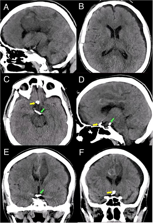 Postoperative head CT. (A, B) Sagittal and axial views show resolution of the hematoma and intraventricular hemorrhage with remaining postinfarction areas. (C–F) Postoperative head CT views depict the placement of clips in the accessory A2 artery (yellow arrow) and basilar aneurysm (green arrow).