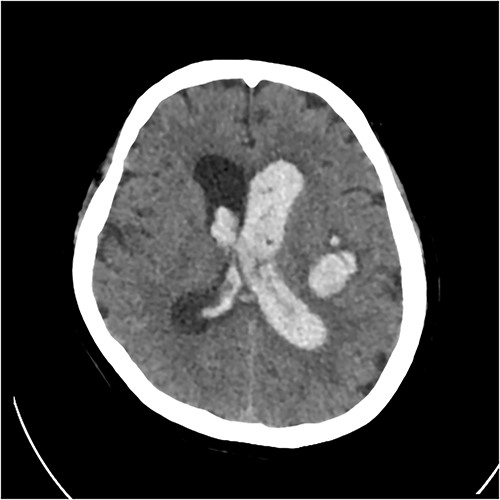 Initial CT revealing acute left-sided intraparenchymal haemorrhage with intraventricular extension and mass effect.