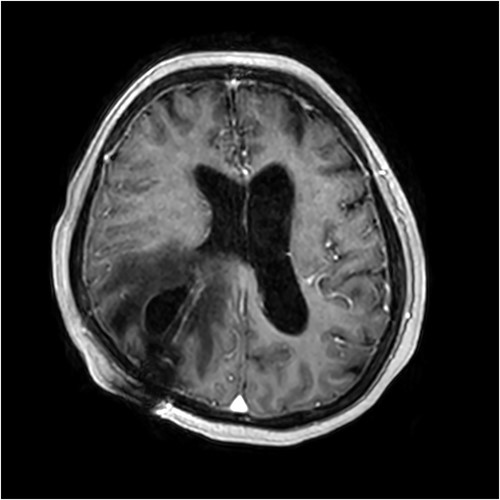 Contrast-enhanced T1-weighted MRI scan showing presence of the intraparenchymal cyst and surrounding vasogenic oedema.