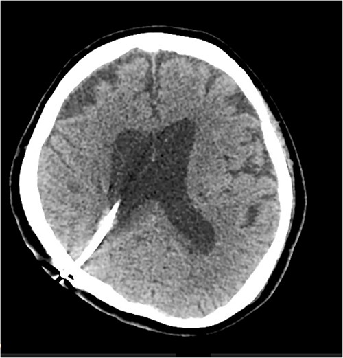 CT scan performed 41 days after shunt revision, showing resolution of the periventricular cyst.
